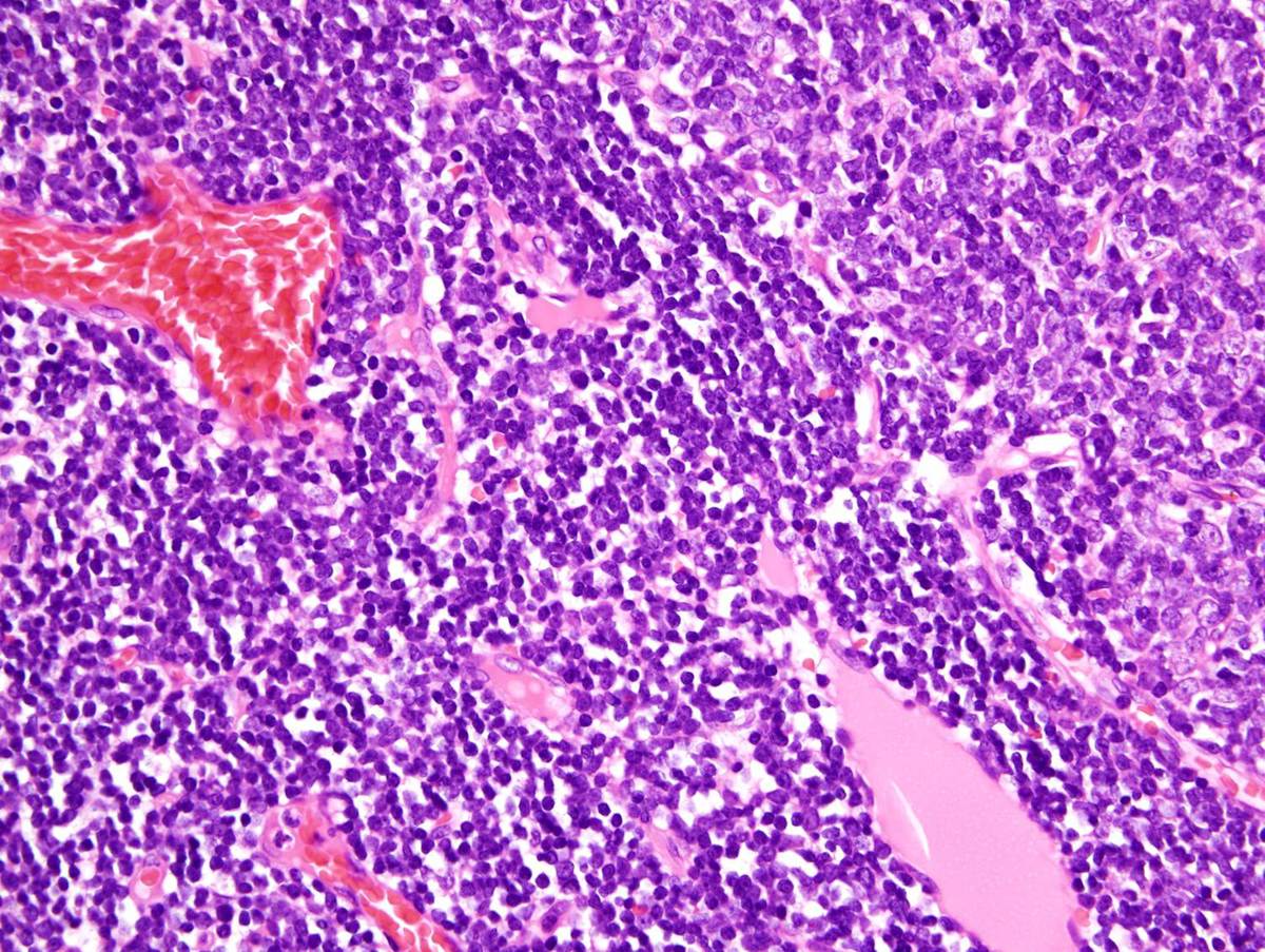 Mediastinal mass, epithelial cell-rich and lymphocyte-rich areas (400x)